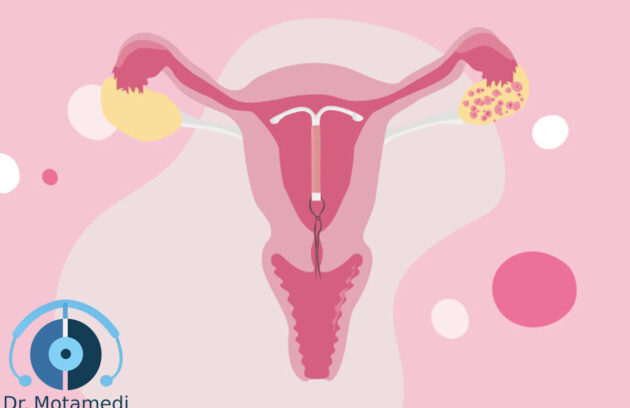 هر آنچه باید در مورد سرطان تخمدان بدانید