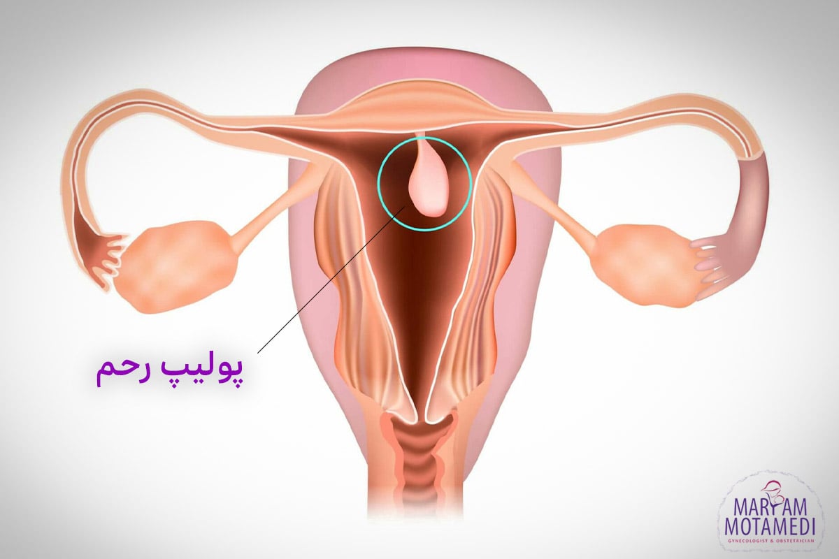 پولیپ رحمی